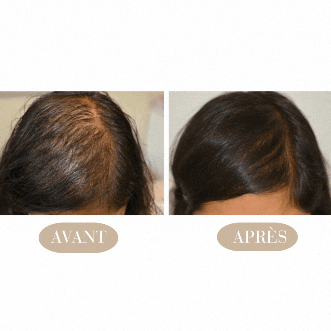 MyBrushCare Pro® – Stimulation capillaire avancée